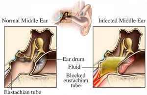medical-illustration-normal-vs-infected-ear